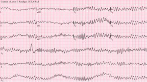 ventricular fibrilation 