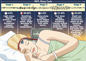 sleep apnea